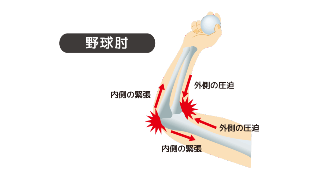 野球肘の原因