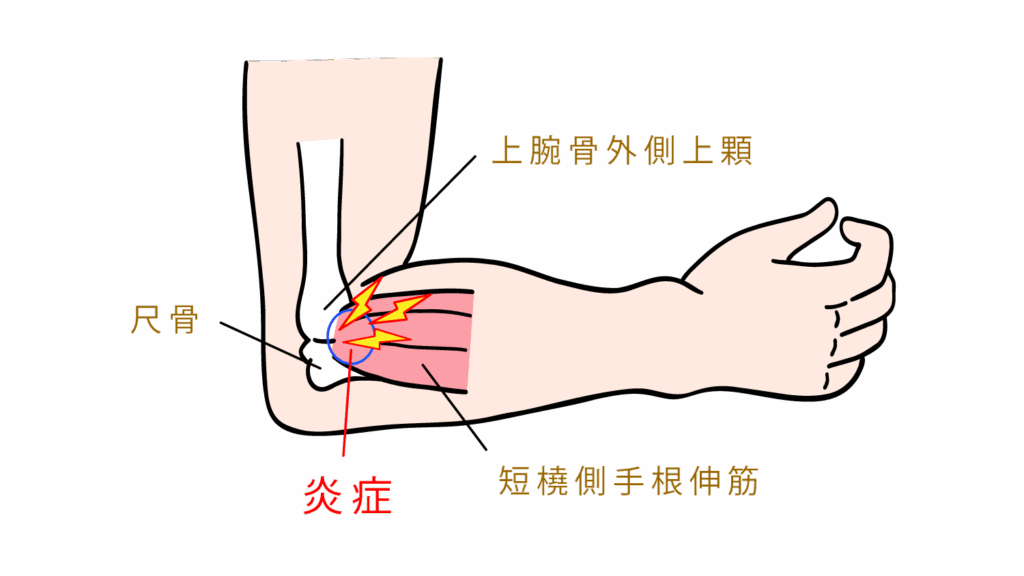 野球肘の傷んだ場所