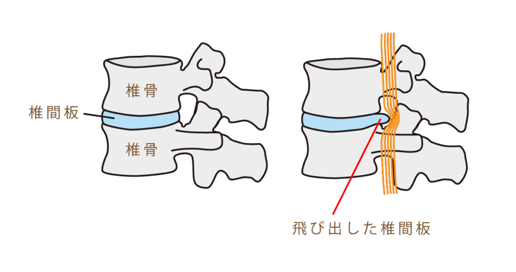 ヘルニアの原因